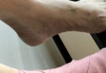 Paripurna, Anggota DPRD Kabupaten Gunungkidul Terjatuh dari Tangga